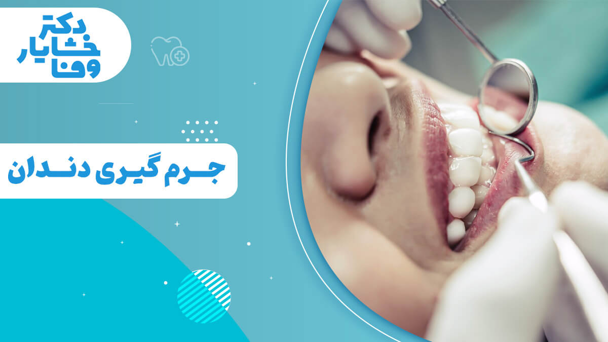 تصویر نزدیک از دهان بیمار در حین جرم‌گیری دندان، که ابزار دندانپزشکی (آینه و جرم‌گیر) و دندان‌های تمیز را نشان می‌دهد.