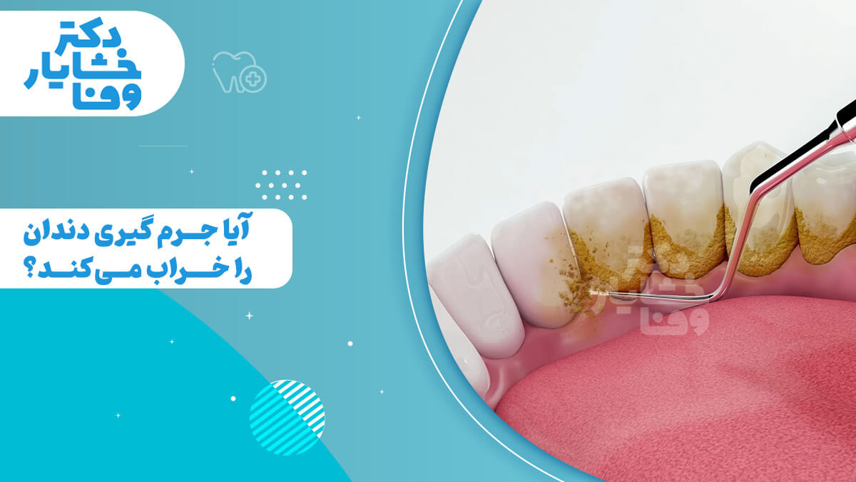 تصویری سه بعدی از جرم دندان و ابزار جرم‌گیری را نشان می‌دهد.