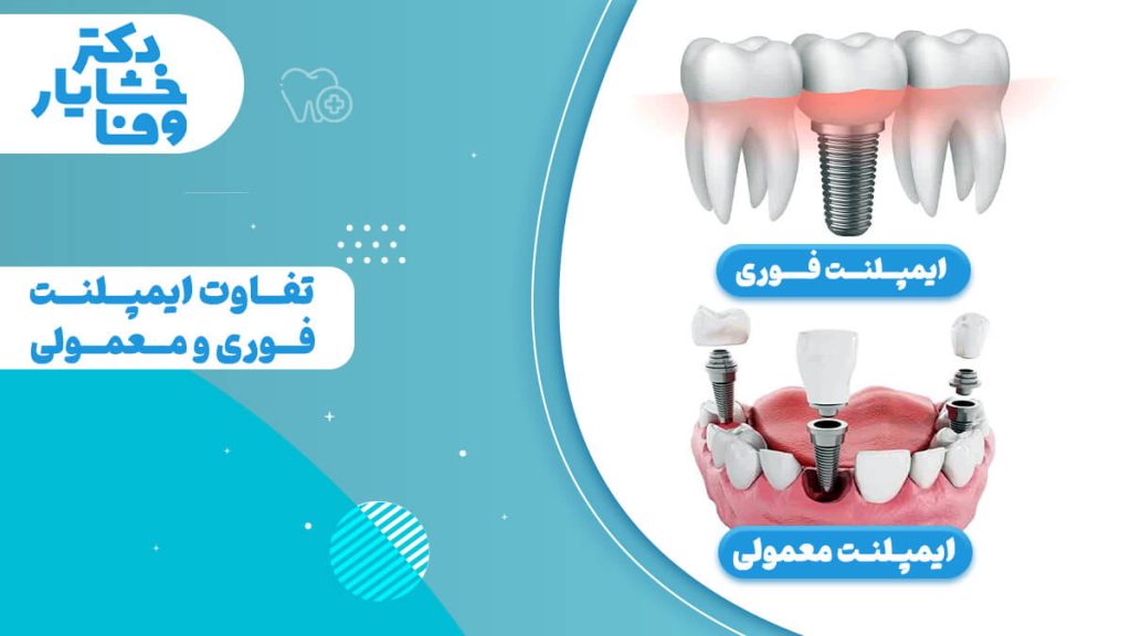 عنوان تفاوت ایمپلنت فوری و معمولی که 2 روش ایمپلنت دندان را به صورت بصری مقایسه می‌کند؛ ایمپلنت فوری که با یک دندان روی پایه مشخص شده و ایمپلنت معمولی با چندین پایه و روکش مجزا