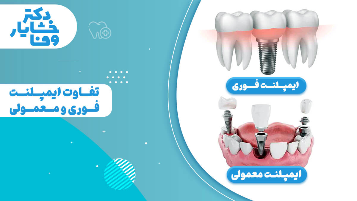 عنوان تفاوت ایمپلنت فوری و معمولی که 2 روش ایمپلنت دندان را به صورت بصری مقایسه می‌کند؛ ایمپلنت فوری که با یک دندان روی پایه مشخص شده و ایمپلنت معمولی با چندین پایه و روکش مجزا