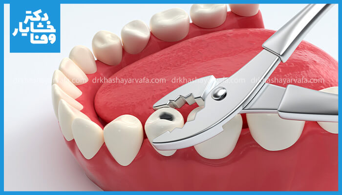 تصویری گرافیکی از فرآیند کشیدن دندان پوسیده با انبر دندانپزشکی، نشاندهنده ابزار و دندان آسیبدیده.