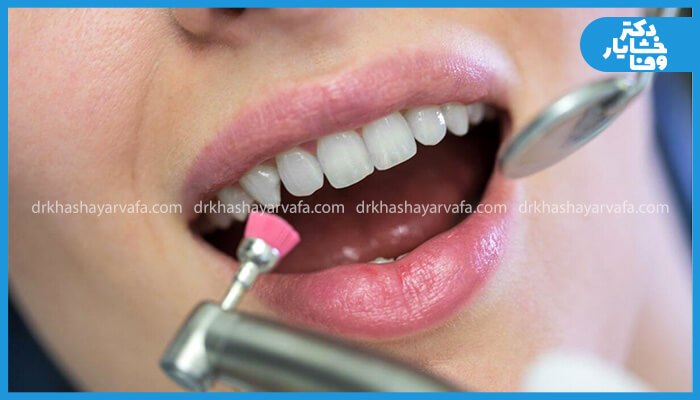 پرداخت دندان با ابزار حرفهای