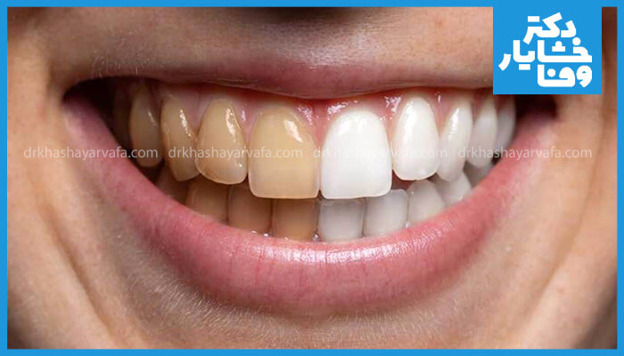 تصویر مقایسه‌ای از دندان‌های یک فرد، که نیمی از دندان‌ها زرد و نیمی سفید و روشن هستند، نشان‌دهنده تاثیر سفید کردن دندان.