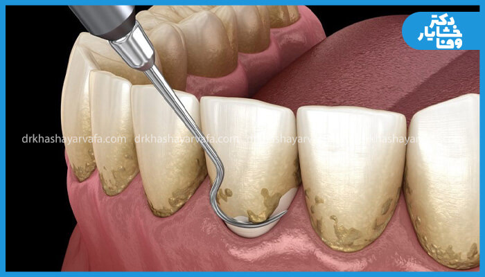 تصویر قبل و بعد از جرمگیری دندان