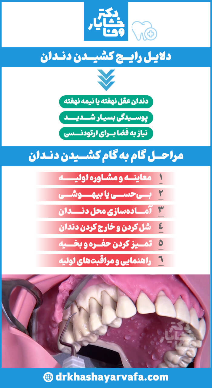 اینفوگرافیک با عنوان "دلایل رایج کشیدن دندان" و "مراحل گام به گام کشیدن دندان" که به ترتیب دلایلی مانند دندان عقل نهفته و پوسیدگی شدید، و مراحل کشیدن دندان از معاینه تا بخیه را توضیح می‌دهد.