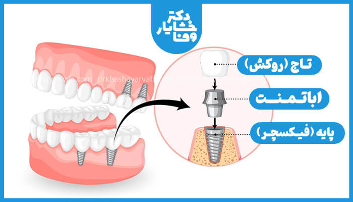 تصویر گرافیکی اجزای ایمپلنت دندان شامل تاج (روکش)، اباتمنت و پایه (فیکسچر) که داخل لثه و استخوان فک قرار گرفته است.