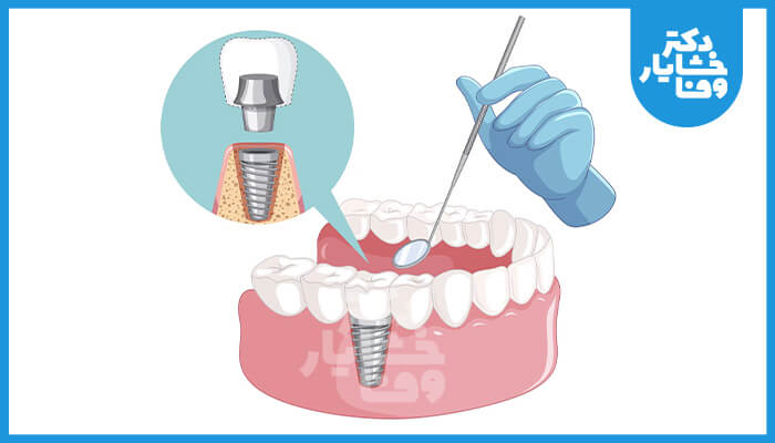 تصویر گرافیکی فرآیند نصب ایمپلنت دندان، با نمایش اباتمنت و تاج که روی فیکسچر قرار گرفته و توسط دندانپزشک با ابزار معاینه میشود.