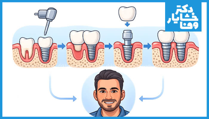 تصویر مراحل کاشت دندان (ایمپلنت) را نشان می‌دهد. این مراحل شامل قرار دادن پایه ایمپلنت، سپس نصب روکش موقت، تثبیت اباتمنت (پایه نگهدارنده)، و در نهایت نصب روکش دائمی است. تصویر یک مرد خندان در پایین به عنوان نتیجه نهایی این فرآیند دیده می‌شود.