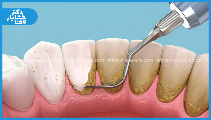 تصویر روش جرمگیری و از بین بردن پلاک دندان