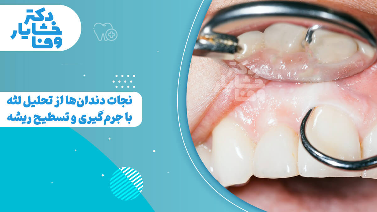 تسطیح ریشه برای جلوگیری از تحلیل لثه