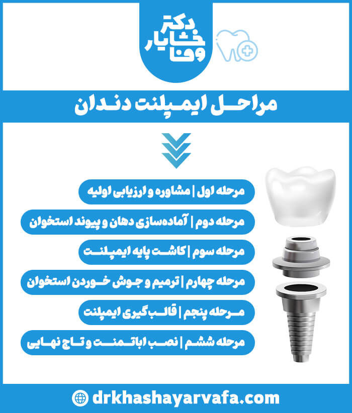 اینفوگرافیک مراحل ششگانه ایمپلنت دندان از مشاوره اولیه تا نصب تاج نهایی.