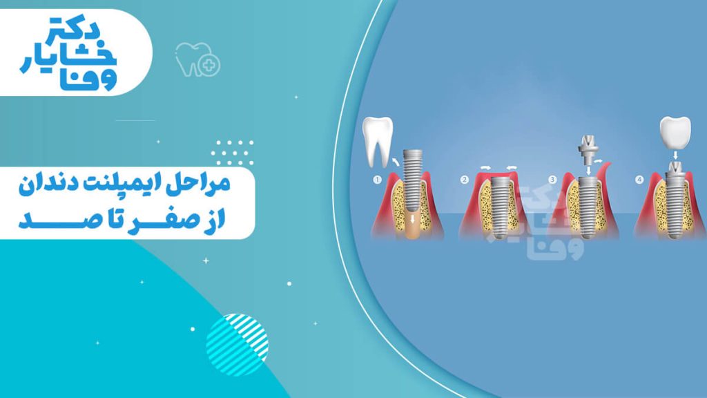 مراحل صفر تا صد ایمپلنت دندان در چهار مرحله شامل قرار دادن فیکسچر در استخوان، جوش خوردن استخوان، اتصال اباتمنت و قرارگیری تاج.