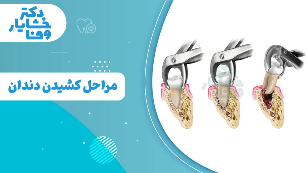 تصویر مراحل کشیدن دندان را نشان می‌دهد، از لق کردن دندان تا بیرون آوردن آن با انبر دندانپزشکی.