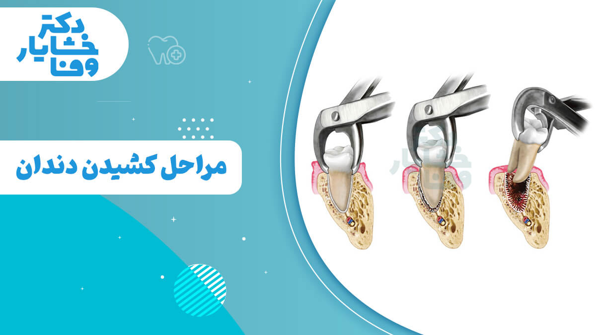 تصویر مراحل کشیدن دندان را نشان میدهد، از لق کردن دندان تا بیرون آوردن آن با انبر دندانپزشکی.