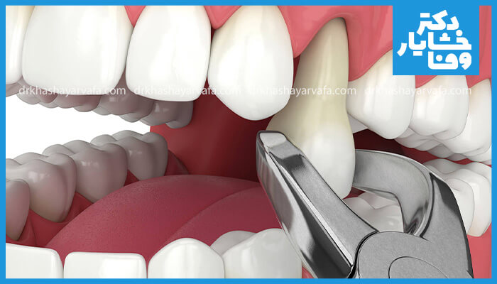 این تصویر یک دندانپزشک را نشان می‌دهد که در حال کشیدن یک دندان از فک بالا با استفاده از انبر دندانپزشکی است.