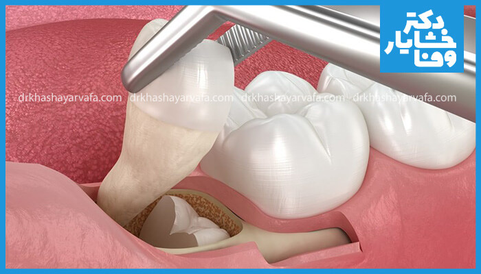 این تصویر کشیدن دندان عقل نهفته را به تصویر می‌کشد که قسمتی از آن زیر لثه قرار دارد و توسط انبر دندانپزشکی گرفته شده است.
