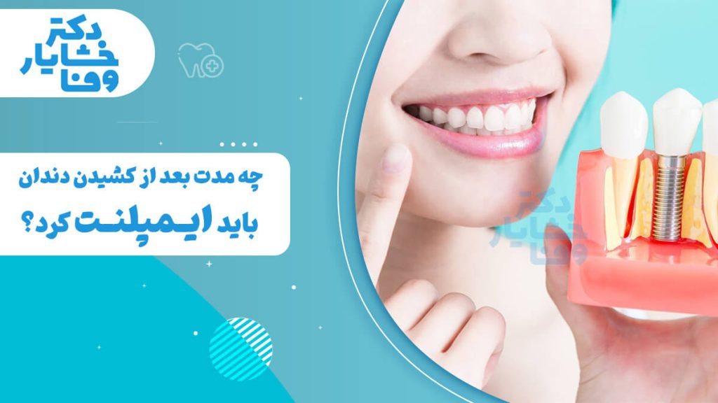 یک زن خندان که مدل مقطعی از یک دندان و ایمپلنت را در دست دارد. متن فارسی روی تصویر می‌پرسد: "چه مدت بعد از کشیدن دندان باید ایمپلنت کرد؟" این تصویر به موضوع زمانبندی کاشت ایمپلنت دندان اشاره دارد.