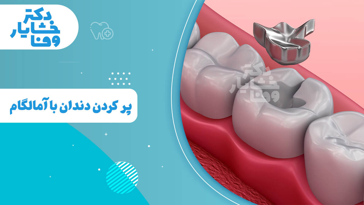 تصویری از دندان‌های پر شده با آمالگام