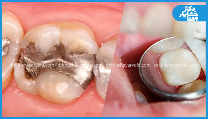 مقایسه دو دندان پر شده. سمت چپ یک دندان با پرکردگی آمالگام قدیمی و سمت راست دندان با پرکردگی کامپوزیت سفید.