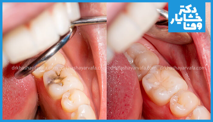 تصویر قبل و بعد از پر کردن دندان با مواد کامپوزیت در ایران، یک دندان پوسیده در سمت چپ و دندان ترمیم شده در سمت راست نشان می‌دهد.