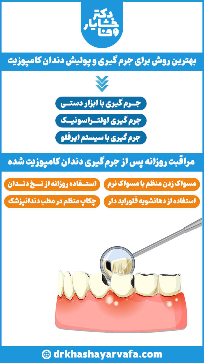 اینفوگرافیک روشهای جرمگیری و پولیش دندان کامپوزیت شده و مراقبتهای روزانه پس از آن.