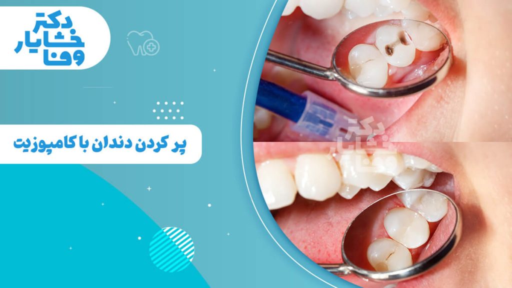 مراحل پر کردن دندان با کامپوزیت در یک کلینیک دندانپزشکی در ایران، تصویر بالا پوسیدگی دندان و تصویر پایین دندان ترمیم شده را نشان می‌دهد.