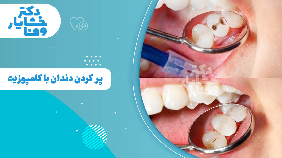 مراحل پر کردن دندان با کامپوزیت در یک کلینیک دندانپزشکی در ایران، تصویر بالا پوسیدگی دندان و تصویر پایین دندان ترمیم شده را نشان می‌دهد.