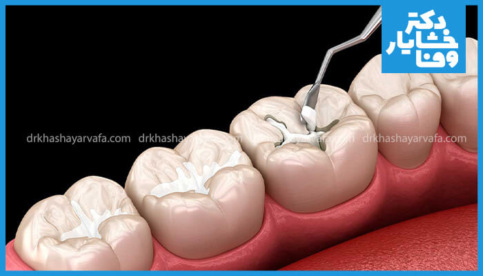 تصویر سه بعدی از پر کردن دندان آسیاب با مواد کامپوزیت. یک ابزار دندانپزشکی در حال شکل دادن به مواد پر کننده روی دندان است.