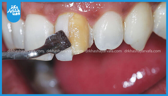 دندانپزشک در حال انجام کامپوزیت یا باندینگ دندان برای ترمیم و زیباسازی دندان جلو