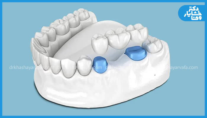  یک دیاگرام سه‌ بعدی که یک بریج دندان را برای جایگزینی دندان از دست رفته نشان می‌دهد. این بریج شامل دو تاج است که روی دندان‌های اطراف قرار می‌گیرند و یک دندان مصنوعی (پونتیک) در میان آن‌ها.