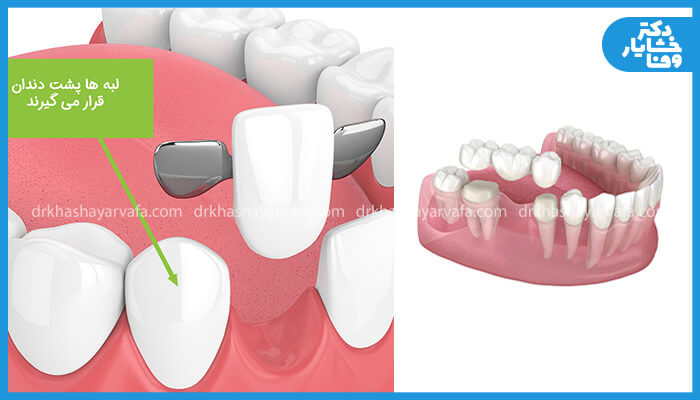 تصویر اصلی یک بریج دندان از نمای نزدیک و از یک بریج کنسول با یک بال فلزی متصل به پشت دندان است. یک تصویر کوچک‌تر نیز یک بریج دندان کامل را نشان می‌دهد که چندین دندان را پوشش می‌دهد. 