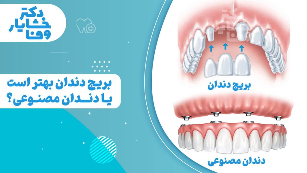 تصویر مقایسه‌ای که یک بریج دندان و یک دندان مصنوعی کامل را نشان می‌دهد. تصویر بریج دندان، تاج‌هایی را روی دندان‌های مجاور با یک دندان جایگزین در وسط نشان می‌دهد. تصویر دندان مصنوعی، یک دست کامل دندان‌های مصنوعی را نشان می‌دهد که توسط ایمپلنت‌ها ثابت شده‌اند.
