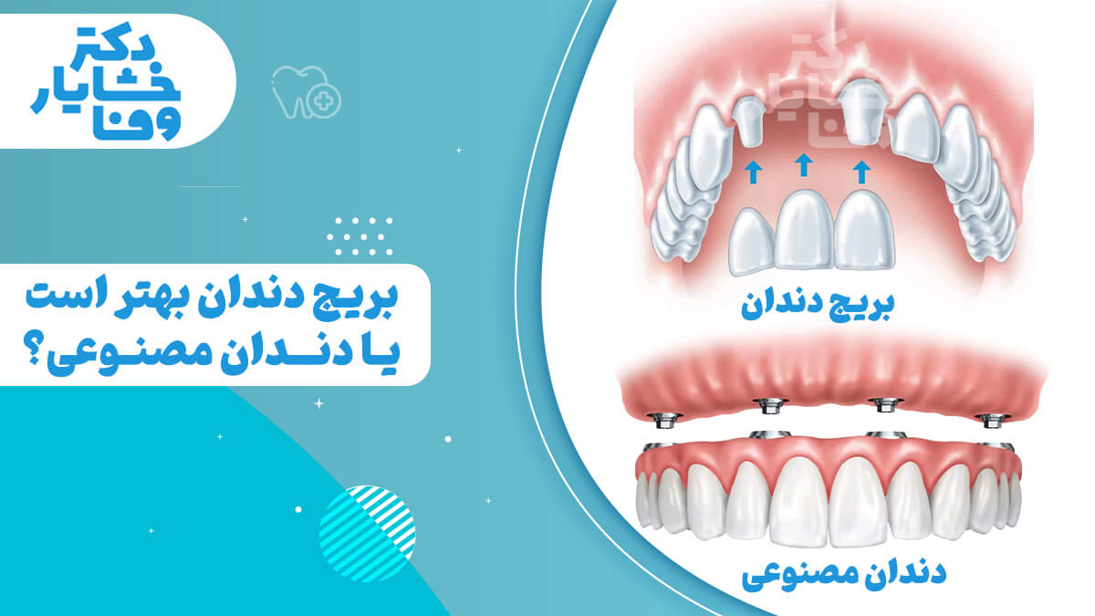 تصویر مقایسه‌ای که یک بریج دندان و یک دندان مصنوعی کامل را نشان می‌دهد. تصویر بریج دندان، تاج‌هایی را روی دندان‌های مجاور با یک دندان جایگزین در وسط نشان می‌دهد. تصویر دندان مصنوعی، یک دست کامل دندان‌های مصنوعی را نشان می‌دهد که توسط ایمپلنت‌ها ثابت شده‌اند.