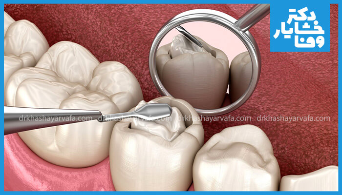 نمای سه بعدی از کاربرد کامپوزیت برای پر کردن دندان. ابزار دندانپزشکی در حال قرار دادن مواد پر کننده سفید رنگ روی دندان است.