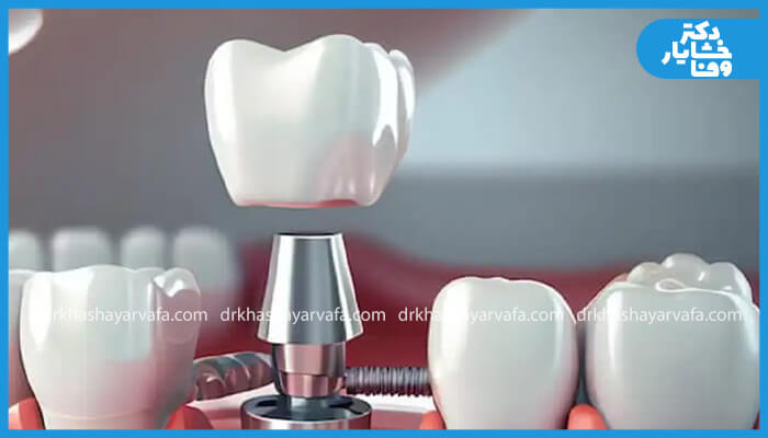 نمای نزدیک از اجزای ایمپلنت شامل اباتمنت و روکش دندانی که آماده نصب است.