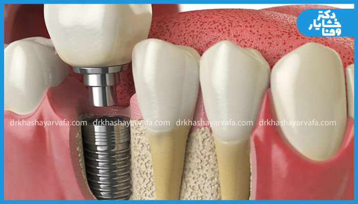 نمای نزدیک از ایمپلنت دندانی کاشته شده در فک، با فیکسچر، اباتمنت و روکش.