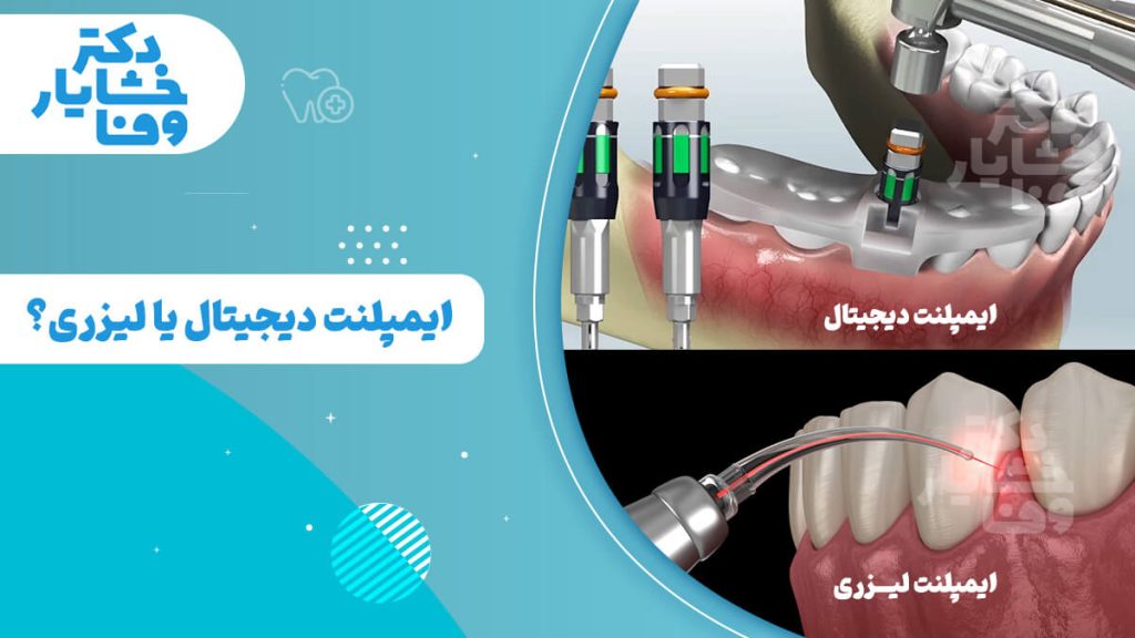 تصویر مقایسه‌ای از روش‌های ایمپلنت دیجیتال و ایمپلنت لیزری