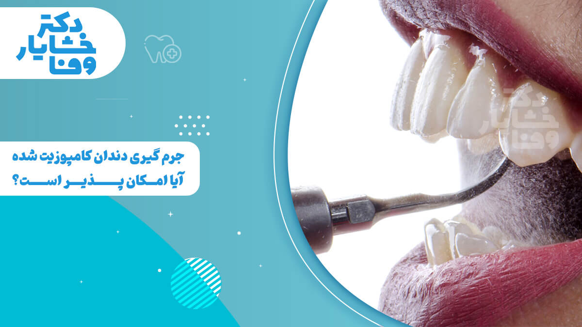 تصویر مقایسهای از دندانپزشک در حال جرمگیری دندان کامپوزیت شده.