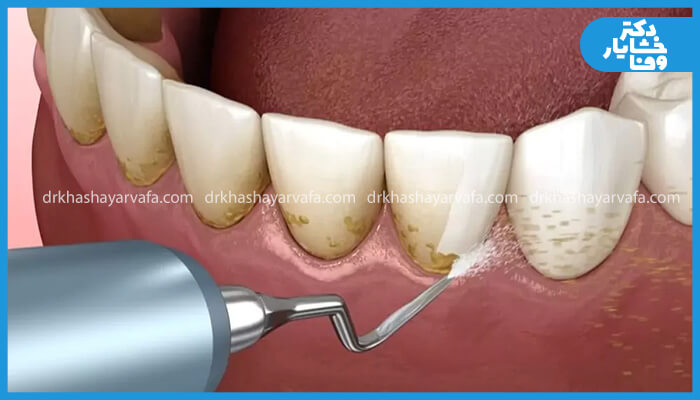 تصویر مقایسهای از دندانپزشک در حال جرمگیری دندان کامپوزیت شده.