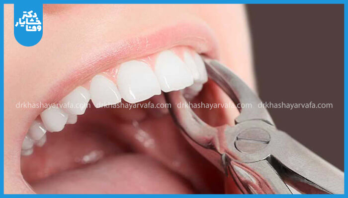 تصویری از کشیدن دندان با استفاده از فورسپس دندانپزشکی