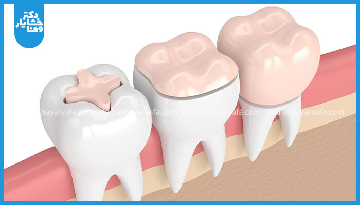 تصویر شماتیک سه دندان آسیاب با انواع ترمیمهای دندان شامل پرکردن، اینله و آنله