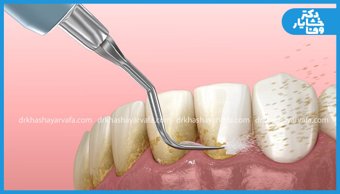 تصویر شماتیک از جرمگیری دندانهای لکهدار با ابزار اولتراسونیک.
