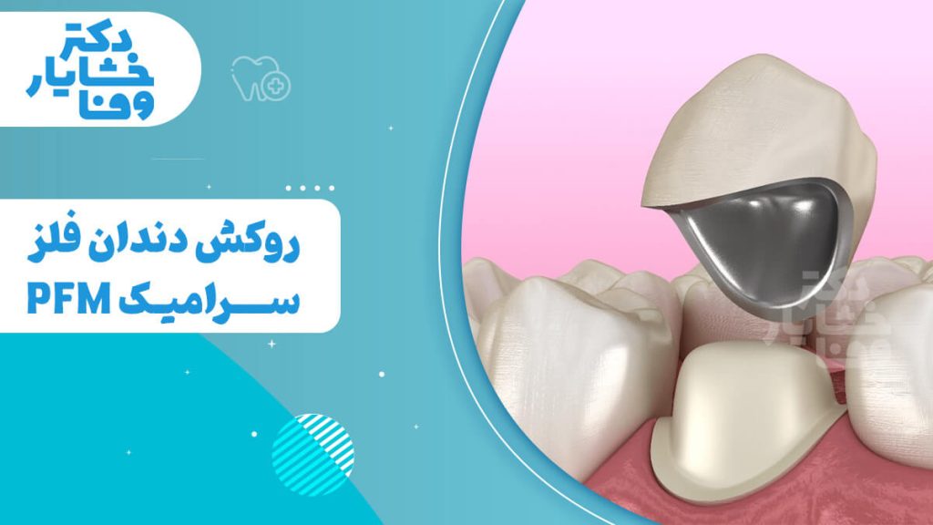 تصویری از یک روکش دندان PFM (پرسلن فیوز به فلز) که به صورت مقطعی روی یک دندان قرار گرفته است. روکش دارای پایه فلزی و لایه سرامیکی روی آن است که ساختار دو قسمتی آن را نشان می‌دهد. عنوان "روکش دندان فلز سرامیک PFM" نیز در تصویر قابل مشاهده است.