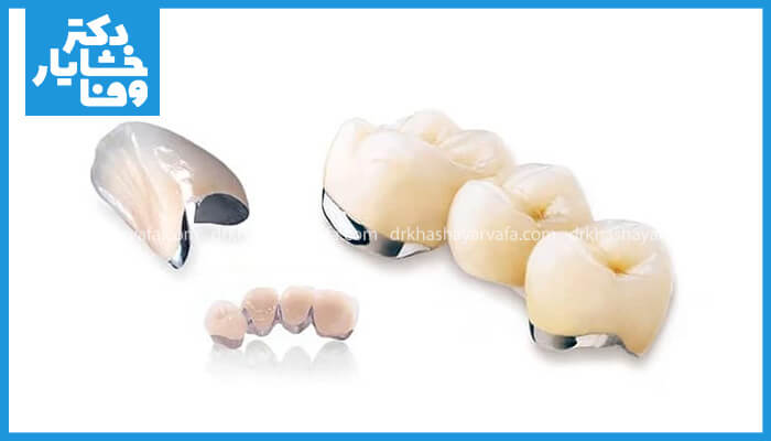  این تصویر که پس‌زمینه‌ای سفید دارد، انواع ترمیم‌های دندانی PFM را نشان می‌دهد. در سمت چپ، یک روکش PFM تکی دیده می‌شود که قسمت سرامیکی و فلزی آن مشخص است. در سمت راست، یک بریج دندانی PFM سه واحدی و در جلوی آن یک بریج کوچک‌تر قرار دارد.