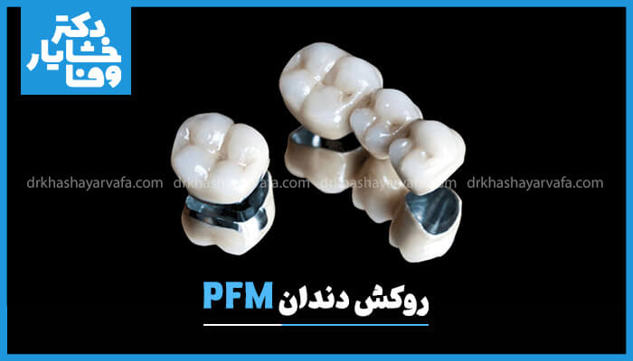یک تصویر از نزدیک از دو بریج دندانی PFM که روی پس‌زمینه‌ای مشکی قرار دارند. روکش‌ها دارای لایه خارجی سرامیکی و چارچوب فلزی نقره‌ای رنگ در زیر آن هستند که ساختار دوگانه مواد PFM را برجسته می‌کند. عبارت "روکش دندان PFM" نیز در پایین تصویر نوشته شده است.
