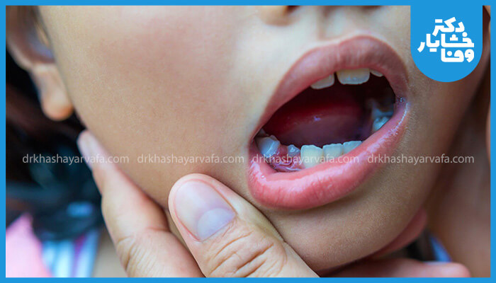 دهان باز یک کودک که دندانهای او توسط یک دندانپزشک یا والدین معاینه میشود. دندانهای شیری و لثه او قابل مشاهده است.