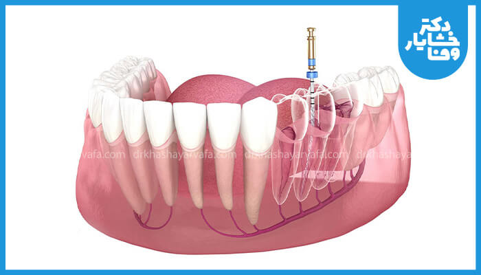 تصویر سه بعدی از فک پایین که فرآیند درمان ریشه دندان را نشان میدهد، شامل تمیز کردن و پر کردن کانال ریشه.