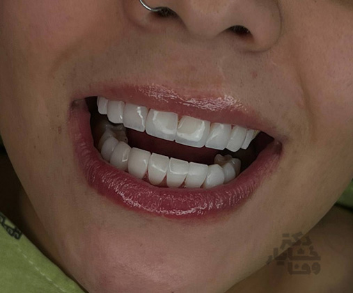 بعد از کامپوزیت دندان توسط دکتر خشایار وفا