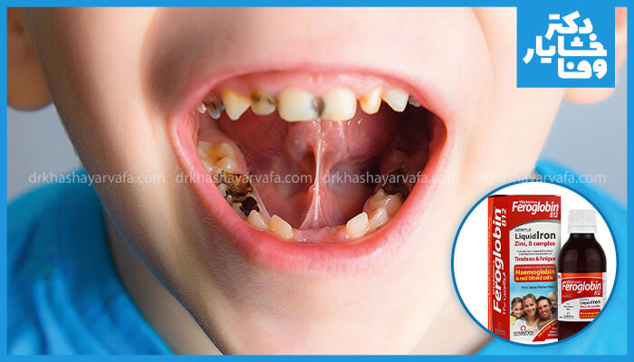 تصویری از دندان‌های کودک با لکه‌های سیاه ناشی از قطره آهن و شربت فرگلوبین در کنار آن