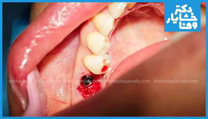 محل قرارگیری فیکسچر ایمپلنت دندان در فک بالا، با خونریزی کم در بافت لثه و نمایان شدن بخشی از فیکسچر فلزی